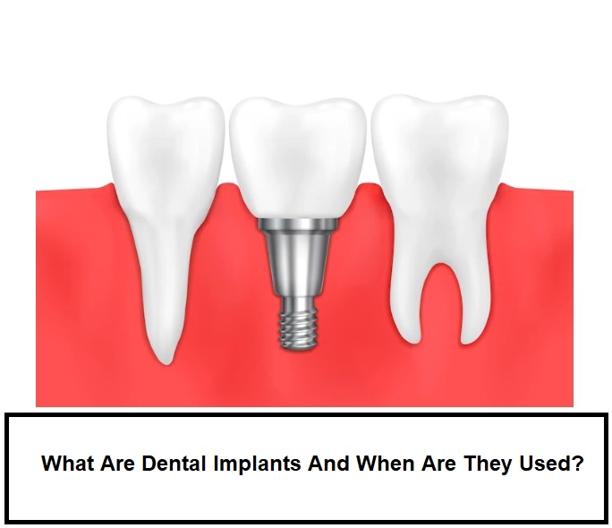 Dental Implants Southeast Edmonton